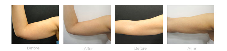 photo showing arms - batwings treated by laser surgery at Aset hospital before and after procedure photographs